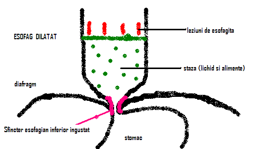 Reflux gastroesofagian