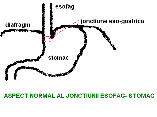 Hernia hiatala si refluxul gastro esofagian | Clinica Gastroenterologie sector 2 Bucuresti